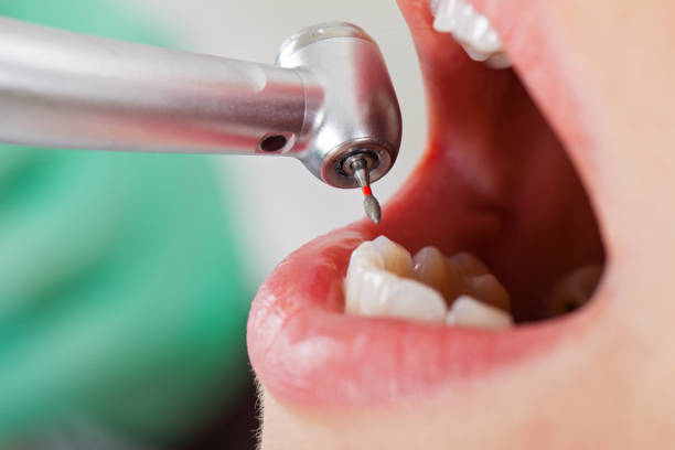 Best Emergency Dentist for Knocked-Out Tooth in San Lorenzo, CA